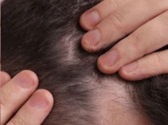 Healthy scalp after ScalpRoot — clear and nourished