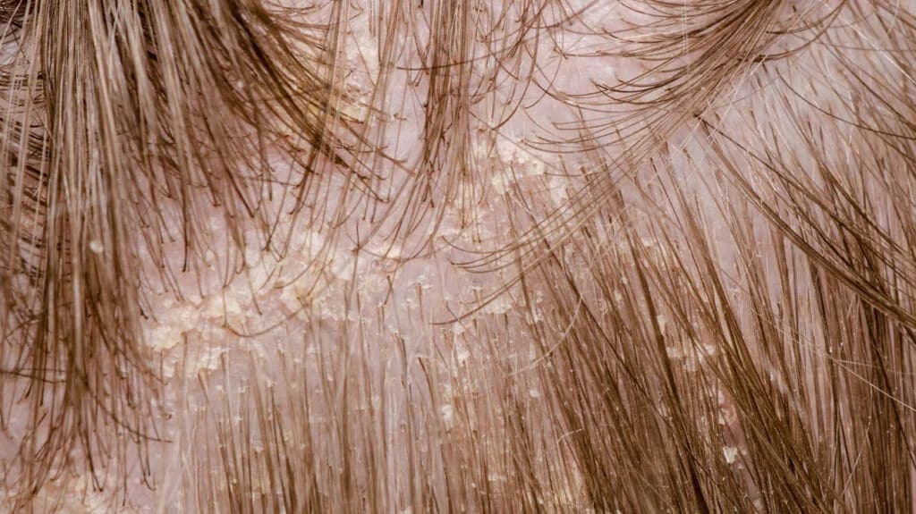 Your Dandruff Doesn't Start On Your Scalp