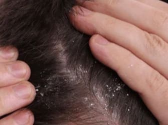 Scalp before ScalpRoot — irritation and flaking