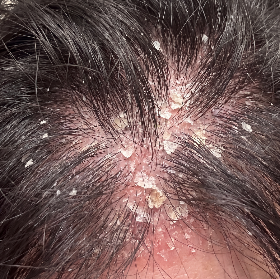 Everyday triggers keep restarting the dandruff cycle